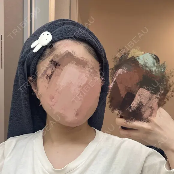 ボトックス（エラ・小顔） / ボトックス（額） / ボトックス（首） Next Tokyo Clinic DAY 7 メイン用