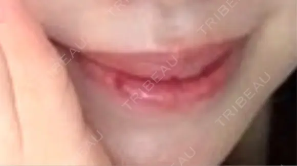 口唇縮小術 Stand by Beauty Clinic AFTER メイン用