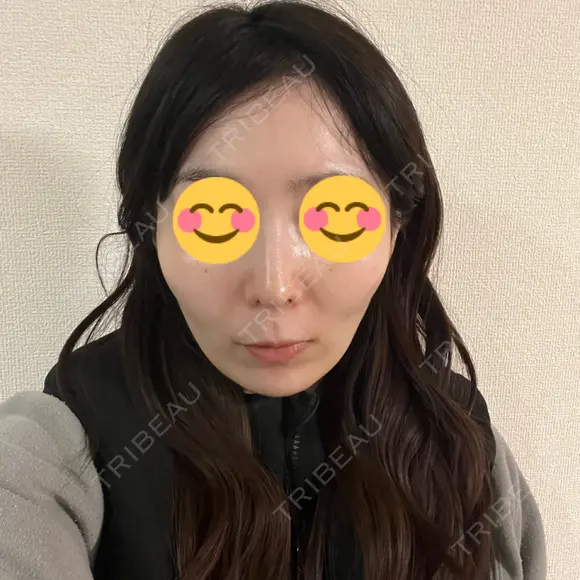 ソフウェーブ アンリクリニック 名古屋院 DAY 6 メイン用