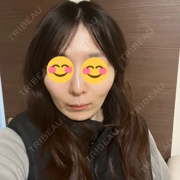 ソフウェーブ アンリクリニック 名古屋院 AFTER メイン用