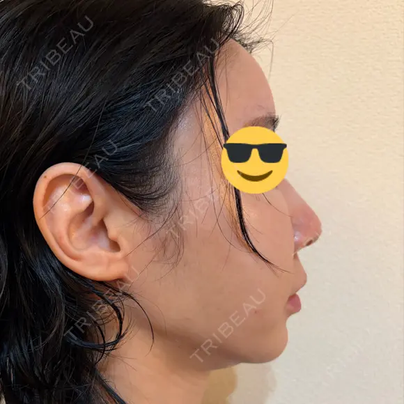 糸リフト / 脂肪吸引（顔） EMMA CLINIC（エマクリニック） DAY 31 メイン用
