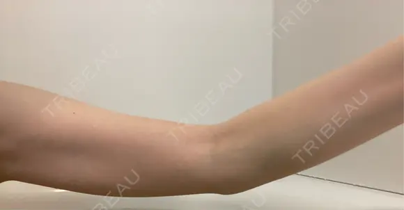 その他（輪郭） 美容皮膚科エルムクリニック 大阪院 DAY 38 メイン用