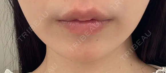 その他（輪郭） 美容皮膚科エルムクリニック 大阪院 DAY 39 メイン用