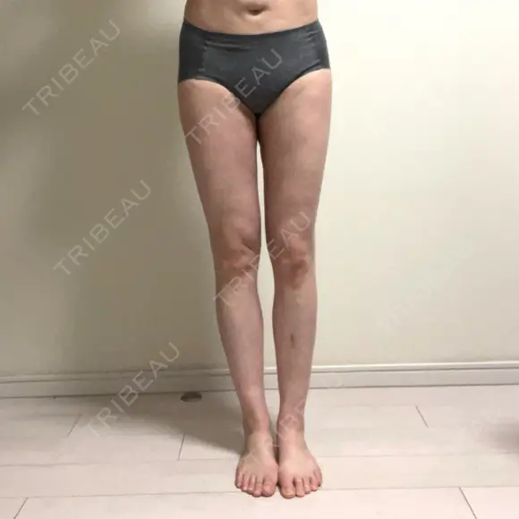 脂肪吸引（脚） / 脂肪吸引（お尻） / 脂肪吸引（腰） GAYA body design clinic DAY 21 メイン用