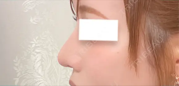 鼻尖形成（切開） / 軟骨移植 / 鼻修正 / 鼻孔縁挙上 / その他（鼻） WOM CLINIC GINZA （ワム クリニック ギンザ） DAY 31 メイン用