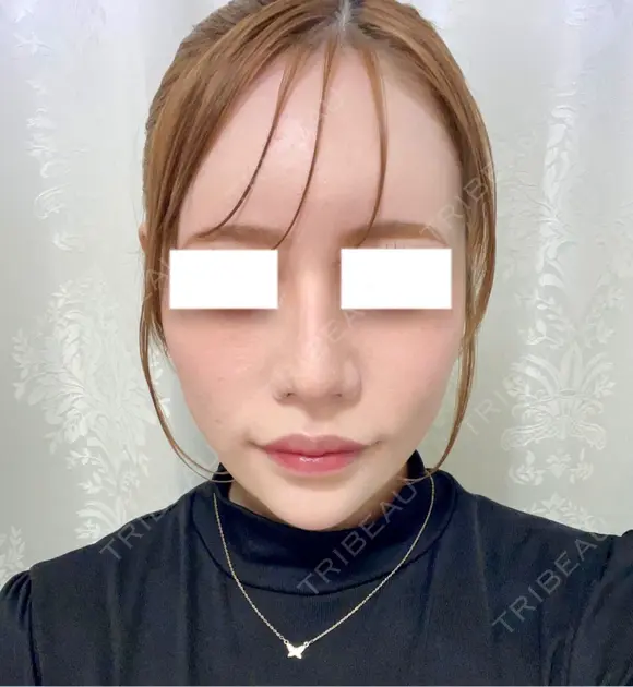 鼻尖形成（切開） / 軟骨移植 / 鼻修正 / 鼻孔縁挙上 / その他（鼻） WOM CLINIC GINZA （ワム クリニック ギンザ） AFTER メイン用