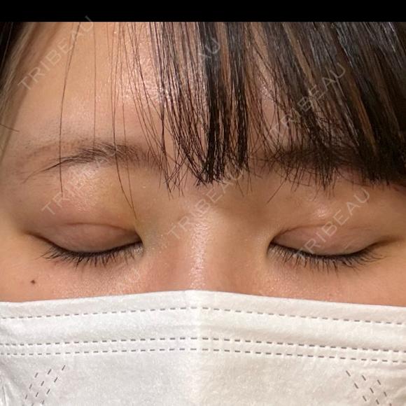 二重埋没 湘南美容クリニック 千葉センシティ院 DAY 2 メイン用