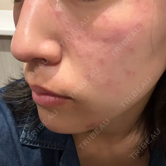 光治療（フォトフェイシャルなど） アクティブエイジクリニック DAY 0 メイン用