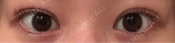 二重埋没 / 目頭切開 EMMO FACE CLINIC 東京三田院 AFTER メイン用