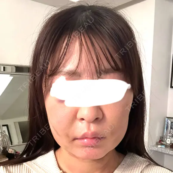 脂肪吸引注射（顔） 新宿美容外科ネビュラクリニック DAY 3 メイン用