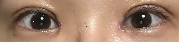 眼瞼下垂（切開） 聖心美容クリニック 六本木院 DAY 22 メイン用