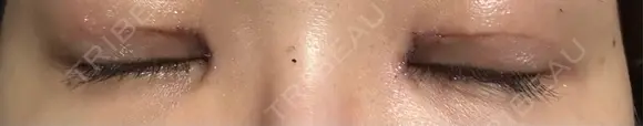 眼瞼下垂（切開） 聖心美容クリニック 六本木院 DAY 22 メイン用