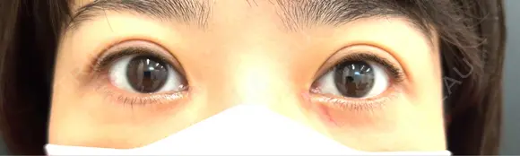 目頭切開 eクリニック 那覇院 DAY 7 メイン用