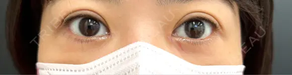 目頭切開 eクリニック 那覇院 DAY 7 メイン用