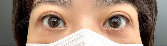 目頭切開 eクリニック 那覇院 DAY 7 メイン用