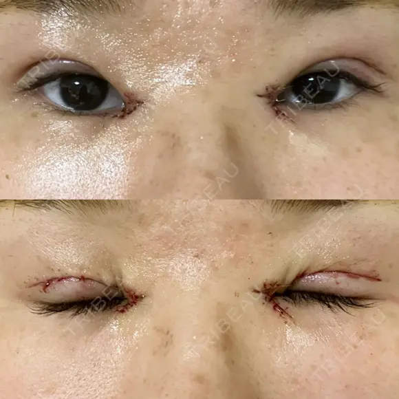 二重切開 / 目頭切開 EMMA CLINIC（エマクリニック） DAY 1 メイン用