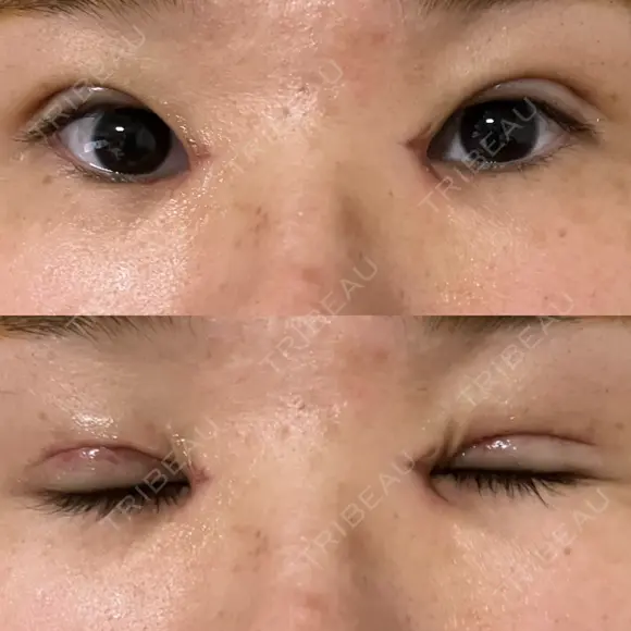 二重切開 / 目頭切開 EMMA CLINIC（エマクリニック） DAY 7 メイン用