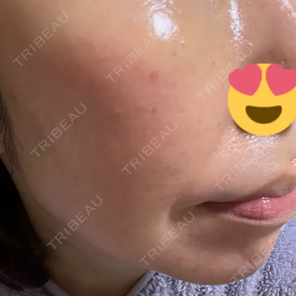 ジャルプロ ゆきスキンクリニック 東池袋 AFTER メイン用