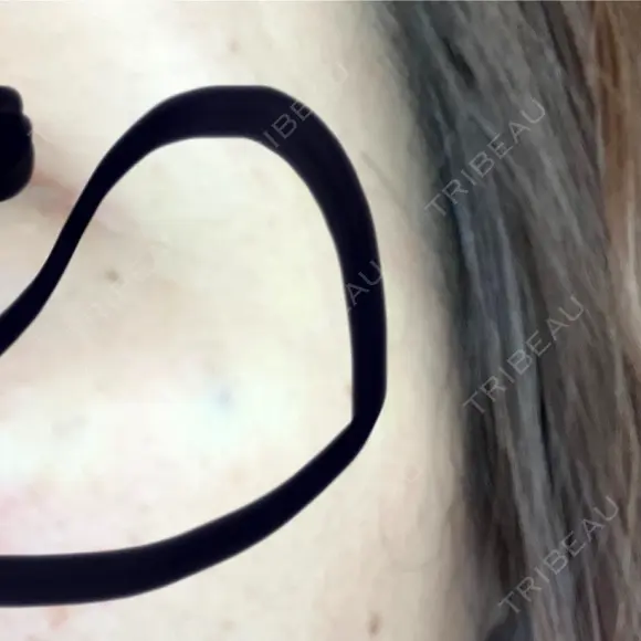 ボトックス（目尻） / ボトックス（額） / その他（目元） 共立美容外科 名古屋院 AFTER メイン用