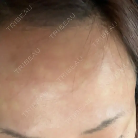 ボトックス（目尻） / ボトックス（額） / その他（目元） 共立美容外科 名古屋院 DAY 0 メイン用