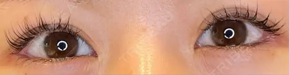 目尻切開 / タレ目形成・グラマラスライン（埋没） LOUIS CLINIC 二子玉川院【ルイクリニック】 DAY 9 メイン用