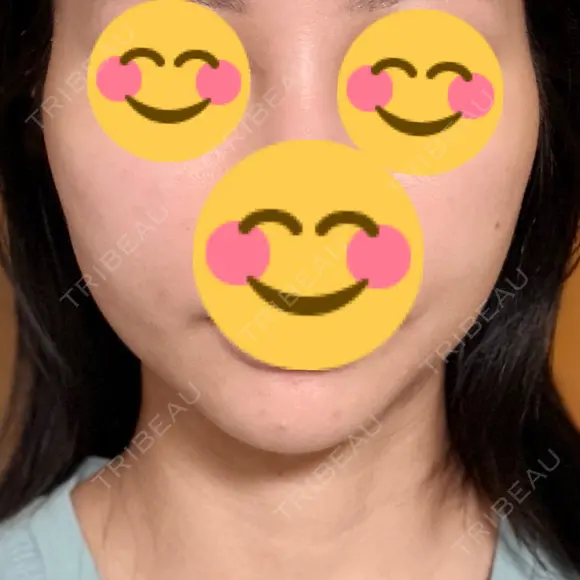 エレクトロポレーション / RF（高周波）たるみ治療 Days Beauty Clinic 新宿院 DAY 1 メイン用