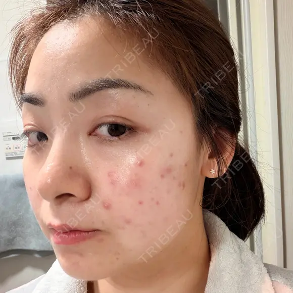 エレクトロポレーション / 光治療（フォトフェイシャルなど） トラスト美容クリニック 銀座院 DAY 1 メイン用