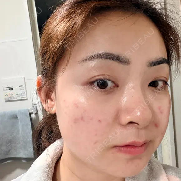 エレクトロポレーション / 光治療（フォトフェイシャルなど） トラスト美容クリニック 銀座院 DAY 1 メイン用