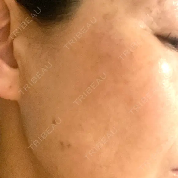 シミ取りレーザー S-Laboクリニック 渋谷院 AFTER メイン用