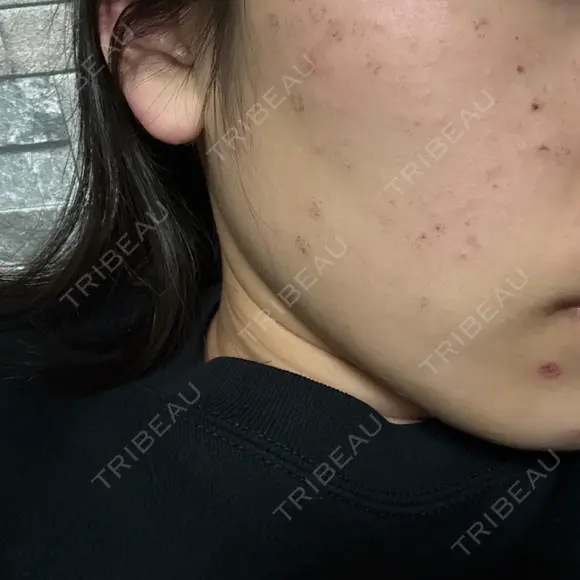 光治療（フォトフェイシャルなど） アクティブエイジクリニック DAY 2 メイン用