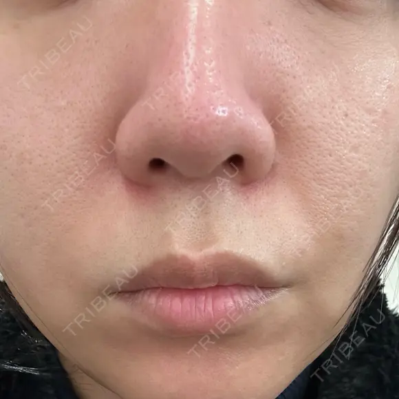 ピーリング（ニキビ・毛穴） ルラ美容クリニック 広島院 AFTER メイン用