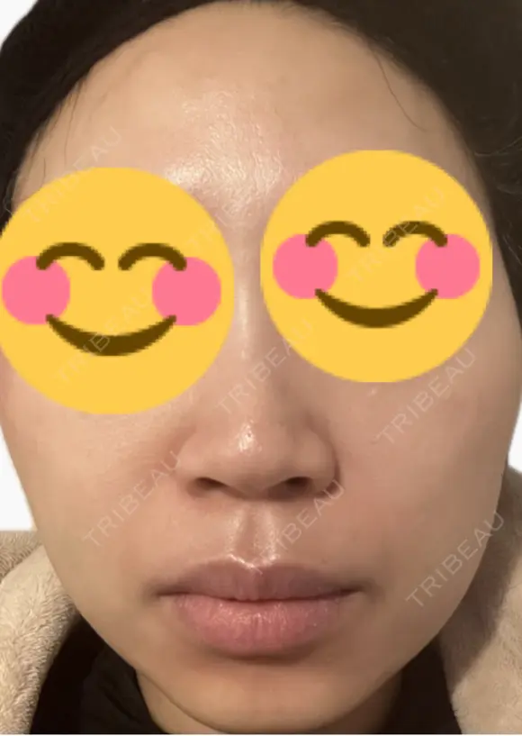 脂肪溶解注射（顔） 上野注入クリニック DAY 8 メイン用