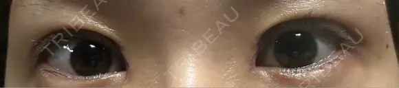 眼瞼下垂（切開） 聖心美容クリニック 六本木院 DAY 24 メイン用