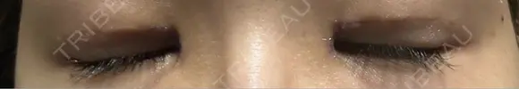眼瞼下垂（切開） 聖心美容クリニック 六本木院 DAY 24 メイン用