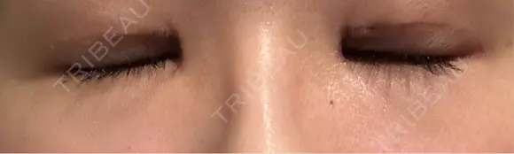 眼瞼下垂（切開） 聖心美容クリニック 六本木院 DAY 25 メイン用