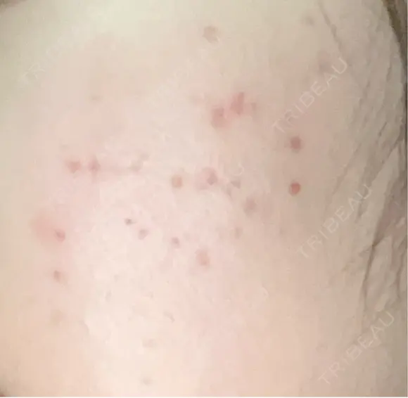 その他（肌） / ポテンツァ ルラ美容クリニック 郡山院 AFTER メイン用