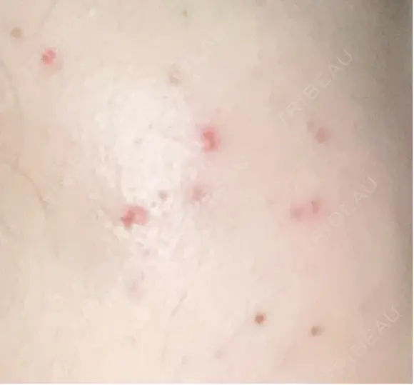 その他（肌） / ポテンツァ ルラ美容クリニック 郡山院 DAY 19 メイン用