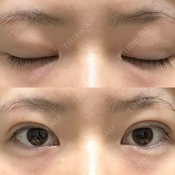 二重埋没 / 上まぶたの脂肪取り アリエル美容クリニック 郡山院 DAY 63 メイン用