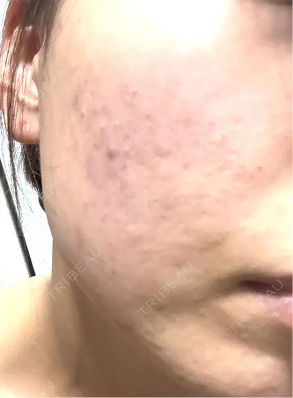 ピーリング（ハリ・ツヤ） / ルメッカ 大美会クリニック 天王寺院 DAY 0 メイン用