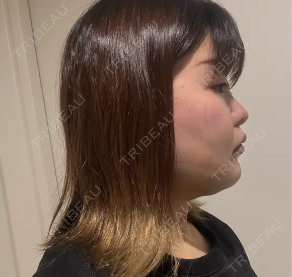 糸リフト / 脂肪吸引（顔） / ボトックス（エラ・小顔） 新宿美容外科ネビュラクリニック DAY 8 メイン用