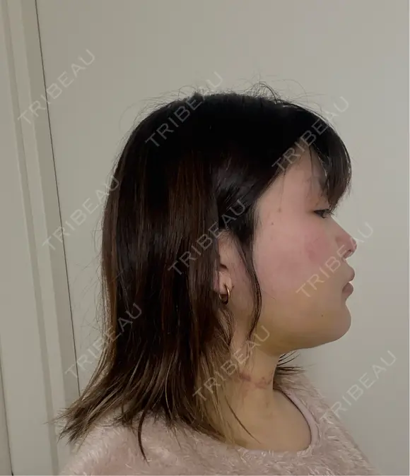 糸リフト / 脂肪吸引（顔） / ボトックス（エラ・小顔） 新宿美容外科ネビュラクリニック DAY 9 メイン用