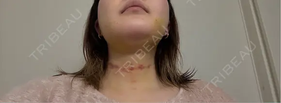 糸リフト / 脂肪吸引（顔） / ボトックス（エラ・小顔） 新宿美容外科ネビュラクリニック DAY 9 メイン用