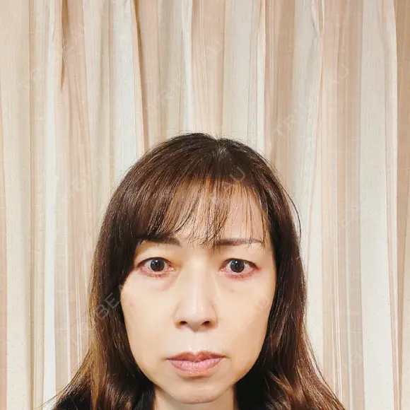 インモード / オンダリフト RIVER CLINIC（リバークリニック） DAY 0 メイン用