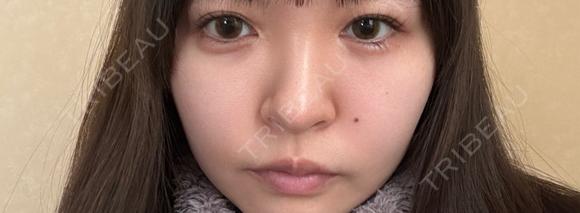 ヒアルロン酸注入（涙袋） / ヒアルロン酸注入（唇） ziz CLINIC AFTER メイン用