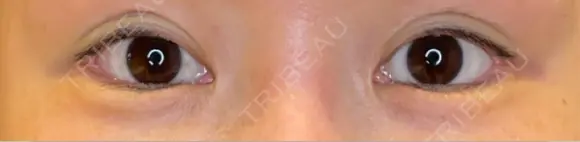 目尻切開 / タレ目形成・グラマラスライン（埋没） LOUIS CLINIC 二子玉川院【ルイクリニック】 AFTER メイン用