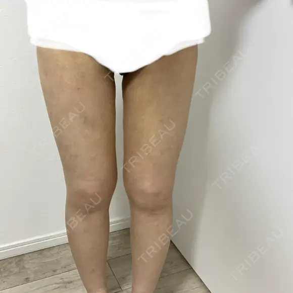 脂肪吸引（脚） / 脂肪吸引（お尻） GAYA body design clinic DAY 15 メイン用