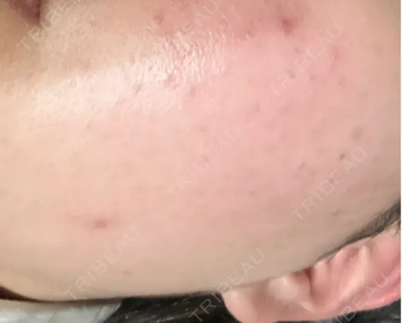 ピーリング（ハリ・ツヤ） ジュエルクリニック 恵比寿院 DAY 3 メイン用
