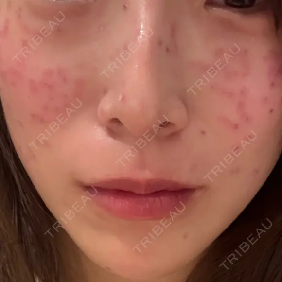 ピコスポット G MEDICAL ART クリニック 新宿院 DAY 0 メイン用