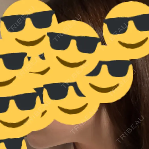 インモード 東京シルククリニック 新宿院 AFTER メイン用