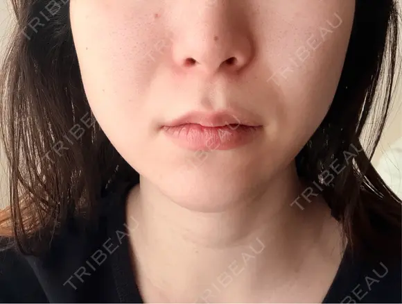 オリジオ Chloe Cheongdam Clinic （クロエチョンダムクリニック） AFTER メイン用